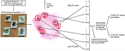 Evaluation of triple negative breast cancer with heterogeneous immune infiltration